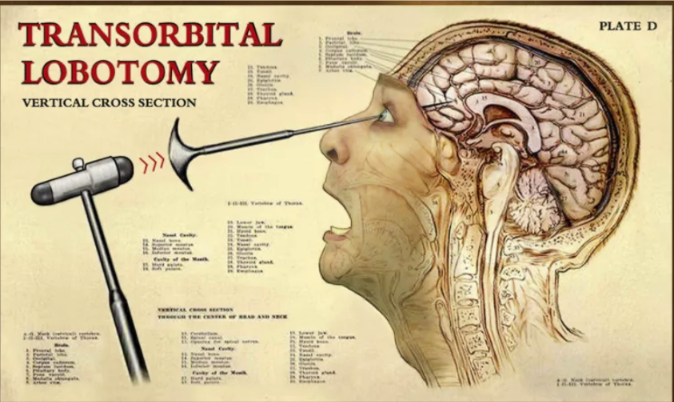 lobotomy sound effect